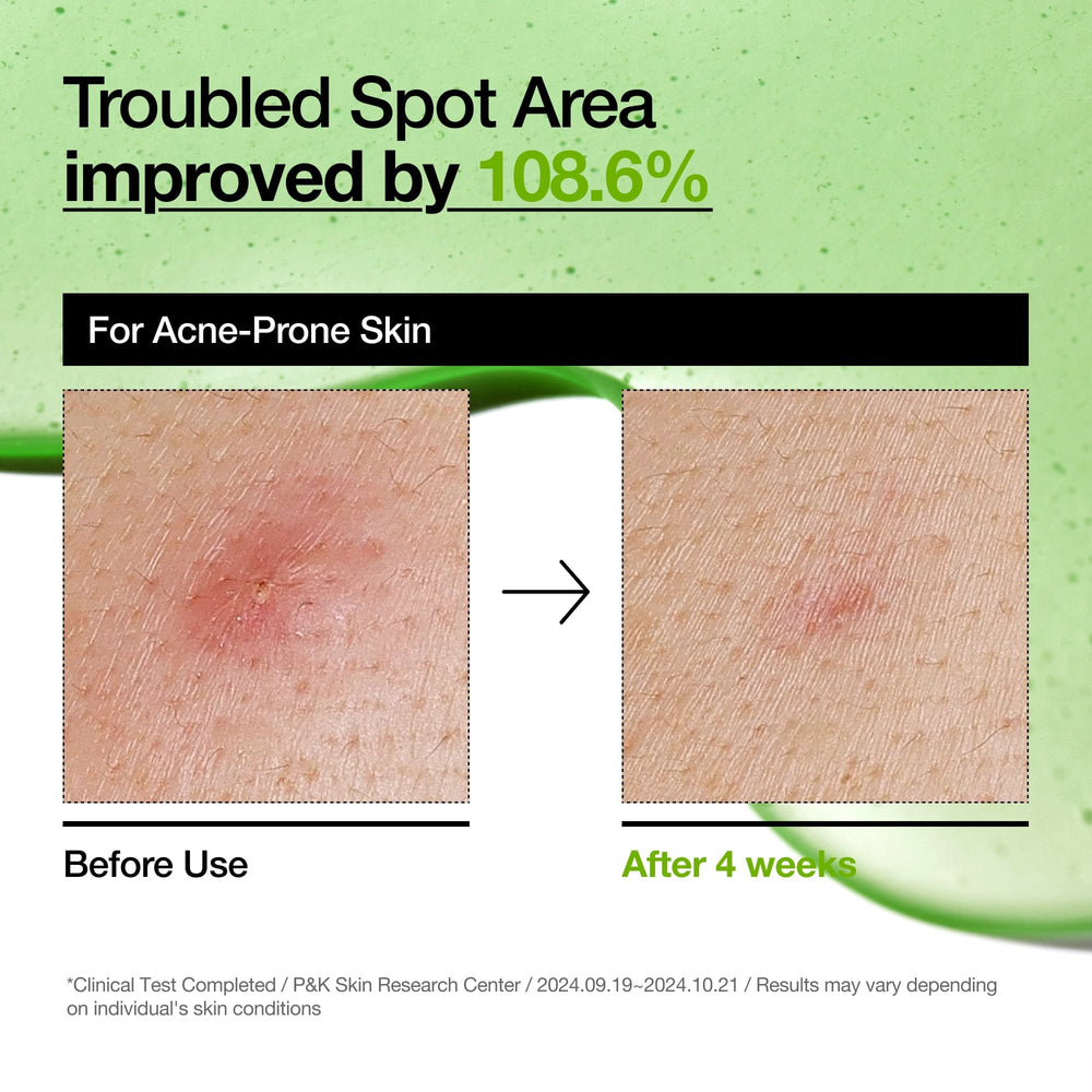 Anua Azelaic Acid 10% Hyaluron Redness Soothing Serum 30ml