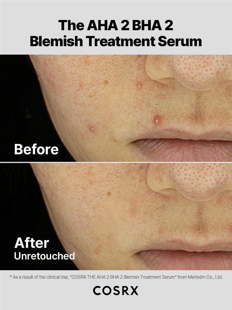 Cosrx The AHA 2 BHA 2 Blemish Treatment Serum