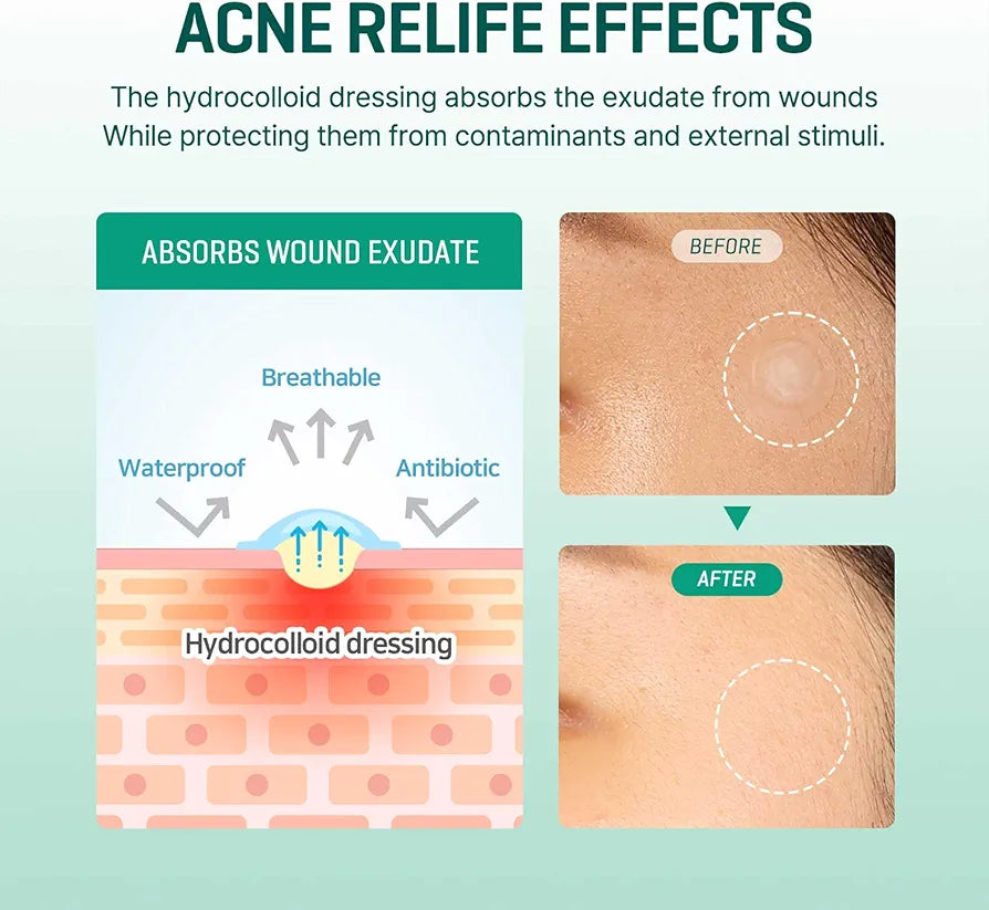 SOME BY MI 30 Days Miracle Clear Spot Patch (18)